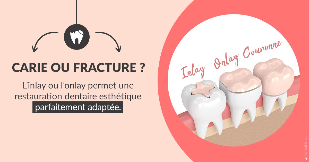 https://dr-boileau-cedric.chirurgiens-dentistes.fr/T2 2023 - Carie ou fracture 2
