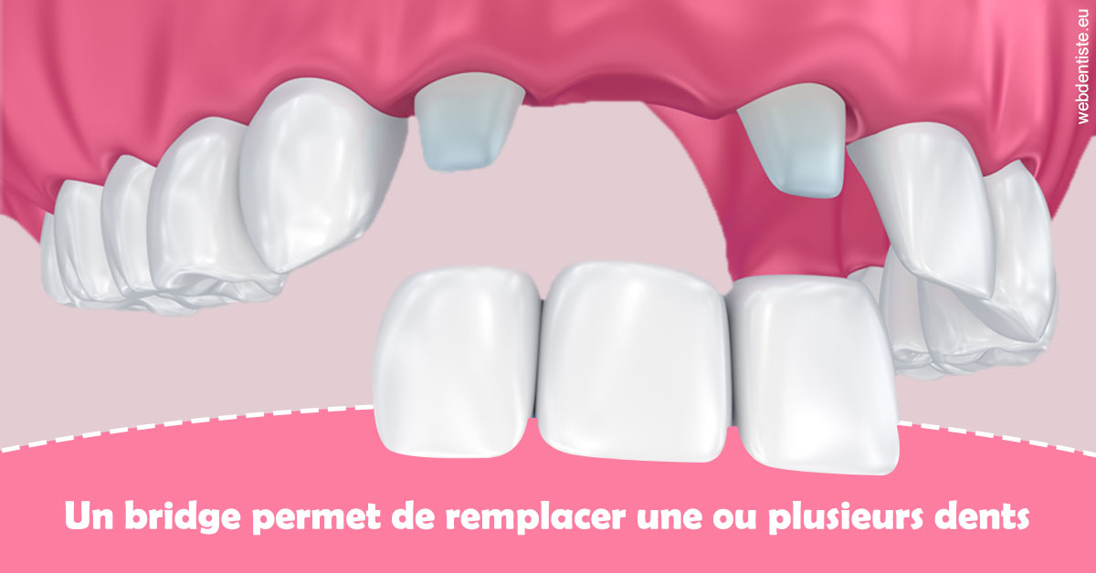 https://dr-boileau-cedric.chirurgiens-dentistes.fr/Bridge remplacer dents 2