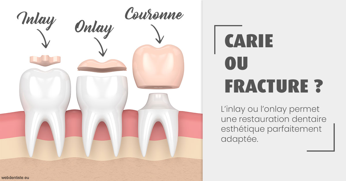 https://dr-boileau-cedric.chirurgiens-dentistes.fr/T2 2023 - Carie ou fracture 1