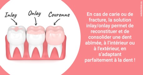 https://dr-boileau-cedric.chirurgiens-dentistes.fr/L'INLAY ou l'ONLAY 2