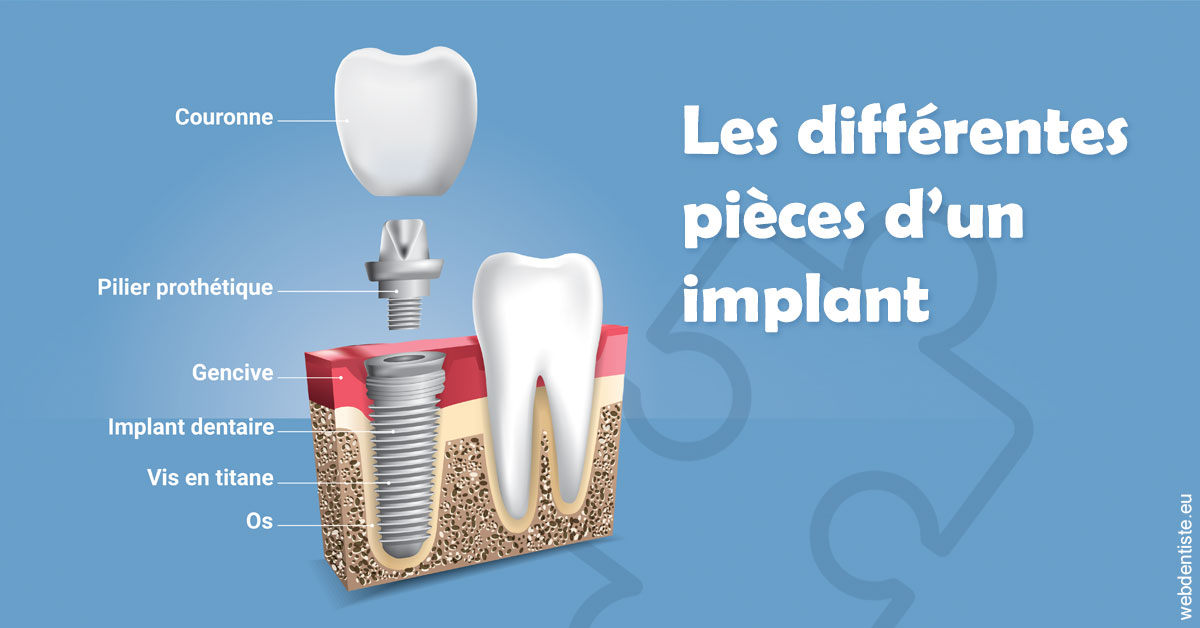 https://dr-boileau-cedric.chirurgiens-dentistes.fr/Les différentes pièces d’un implant 1